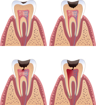 endodonzia